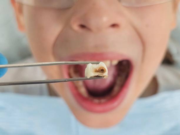 Best Emergency Tooth Extraction in Keaau, HI